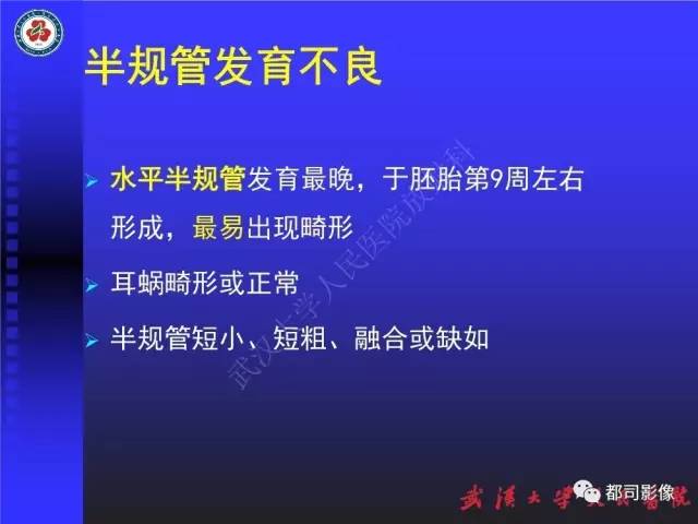 【PPT】先天性内耳畸形影像诊断