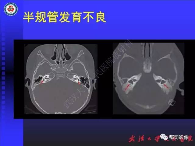 【PPT】先天性内耳畸形影像诊断