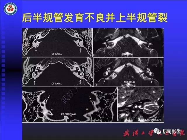 【PPT】先天性内耳畸形影像诊断