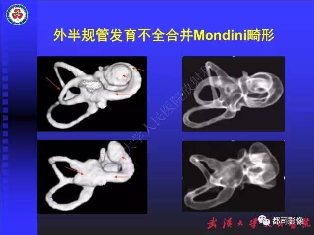【PPT】先天性内耳畸形影像诊断