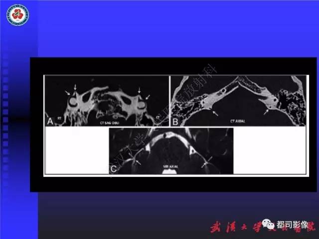 【PPT】先天性内耳畸形影像诊断