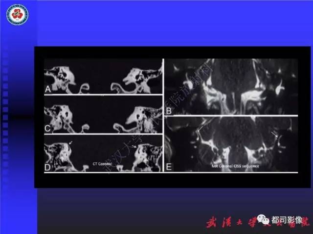 【PPT】先天性内耳畸形影像诊断