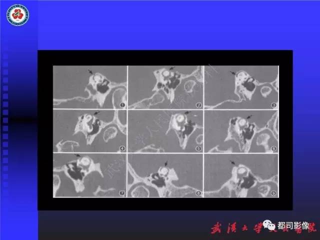 【PPT】先天性内耳畸形影像诊断