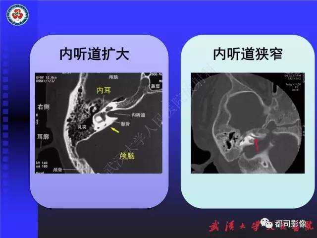 【PPT】先天性内耳畸形影像诊断