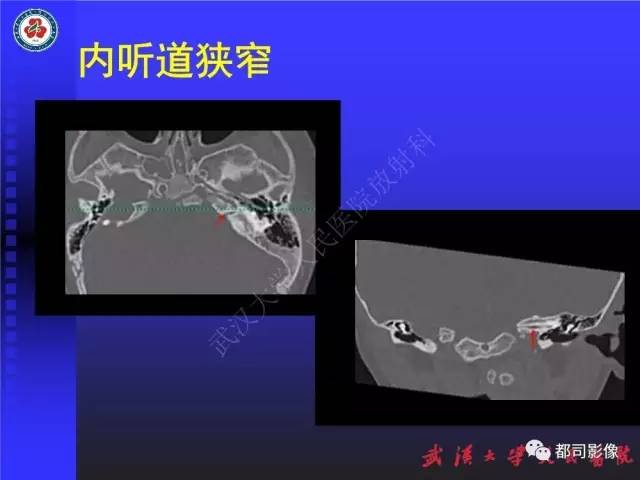 【PPT】先天性内耳畸形影像诊断