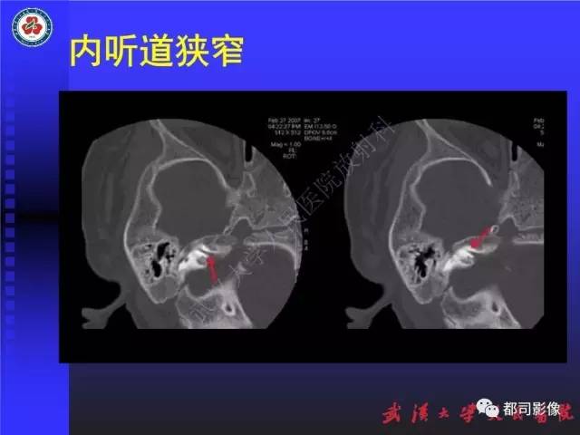 【PPT】先天性内耳畸形影像诊断