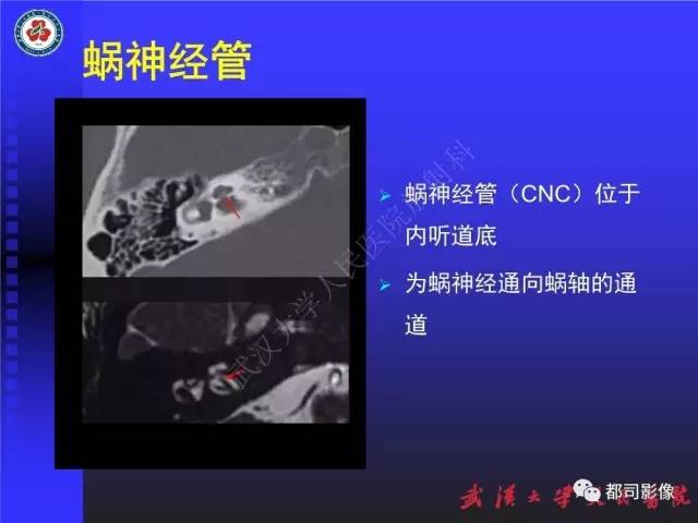 【PPT】先天性内耳畸形影像诊断