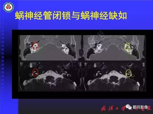 【PPT】先天性内耳畸形影像诊断