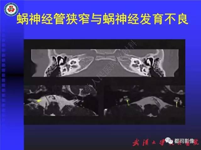 【PPT】先天性内耳畸形影像诊断