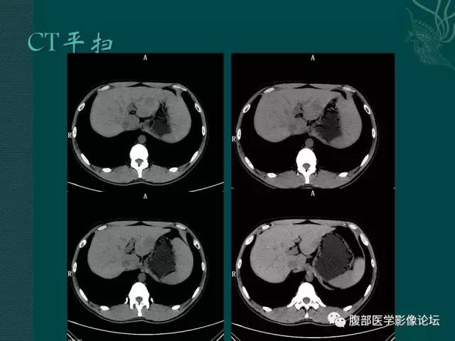【病例】肝脏炎性肌纤维母细胞瘤1例CT及MR