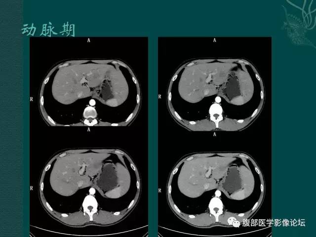 【病例】肝脏炎性肌纤维母细胞瘤1例CT及MR