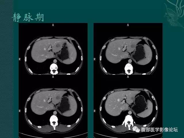 【病例】肝脏炎性肌纤维母细胞瘤1例CT及MR