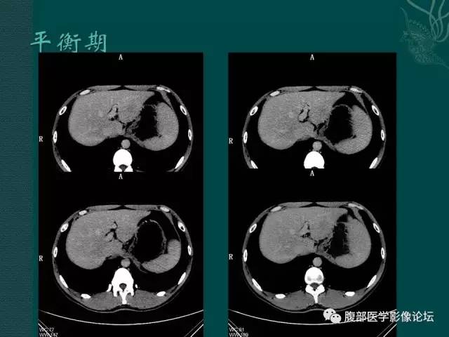 【病例】肝脏炎性肌纤维母细胞瘤1例CT及MR