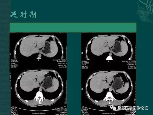 【病例】肝脏炎性肌纤维母细胞瘤1例CT及MR