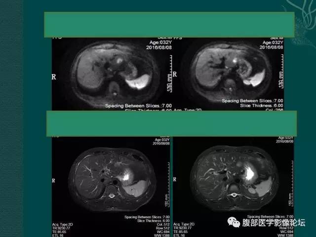 【病例】肝脏炎性肌纤维母细胞瘤1例CT及MR
