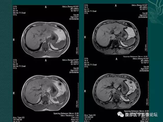 【病例】肝脏炎性肌纤维母细胞瘤1例CT及MR