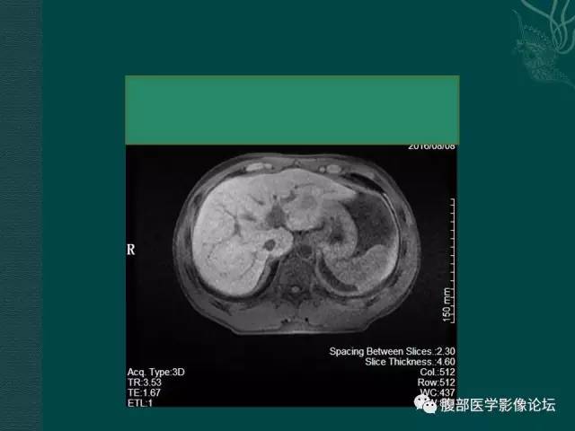【病例】肝脏炎性肌纤维母细胞瘤1例CT及MR