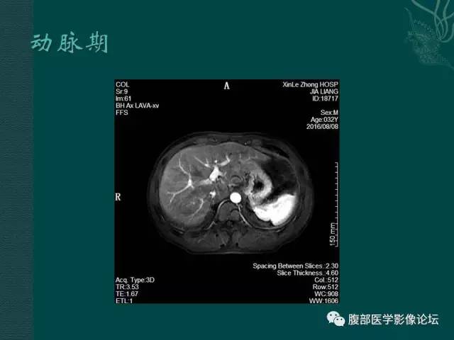 【病例】肝脏炎性肌纤维母细胞瘤1例CT及MR