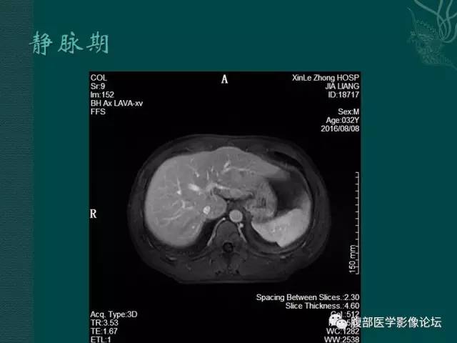 【病例】肝脏炎性肌纤维母细胞瘤1例CT及MR