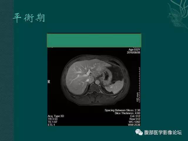 【病例】肝脏炎性肌纤维母细胞瘤1例CT及MR