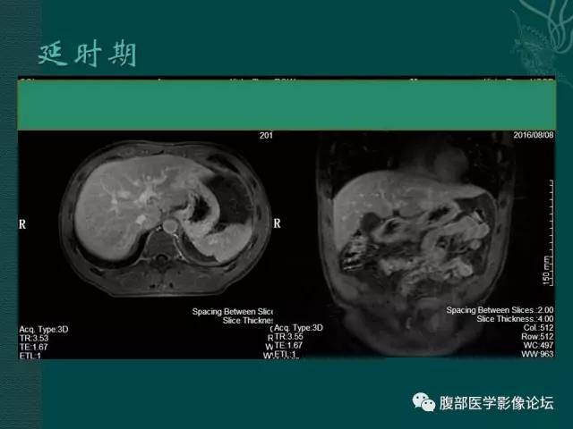 【病例】肝脏炎性肌纤维母细胞瘤1例CT及MR