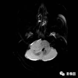 【病例】桥小脑角区脑膜瘤1例MR影像表现