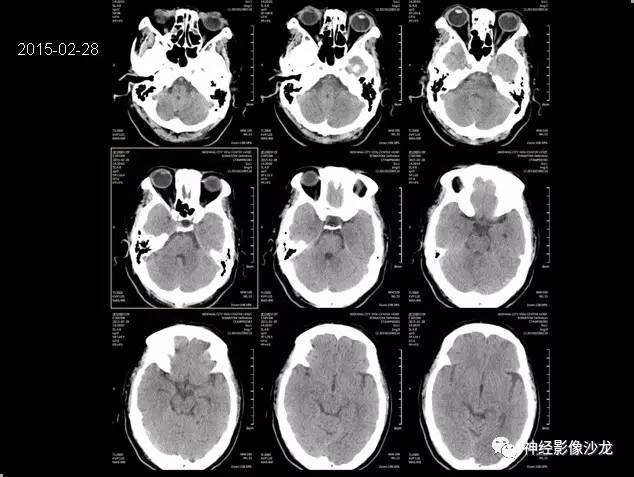 【病例】痛性眼肌麻痹综合征THS一例CT及MR影像表现