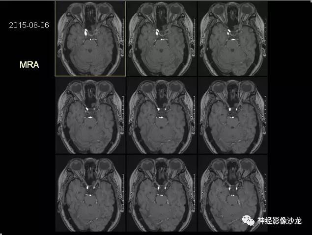 【病例】痛性眼肌麻痹综合征THS一例CT及MR影像表现