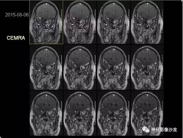 【病例】痛性眼肌麻痹综合征THS一例CT及MR影像表现