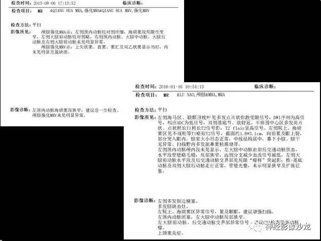 【病例】痛性眼肌麻痹综合征THS一例CT及MR影像表现