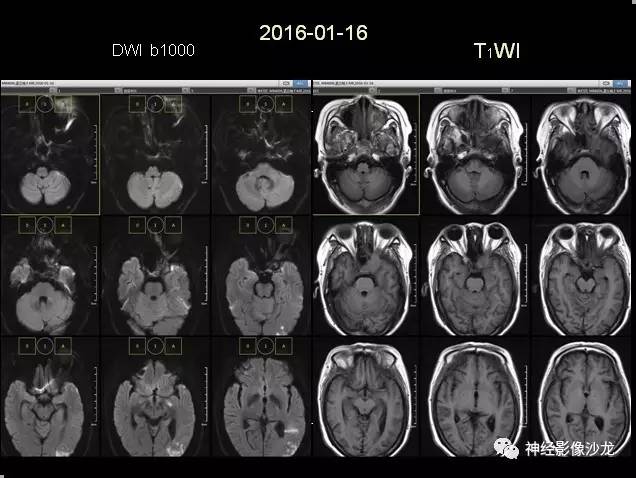 【病例】痛性眼肌麻痹综合征THS一例CT及MR影像表现
