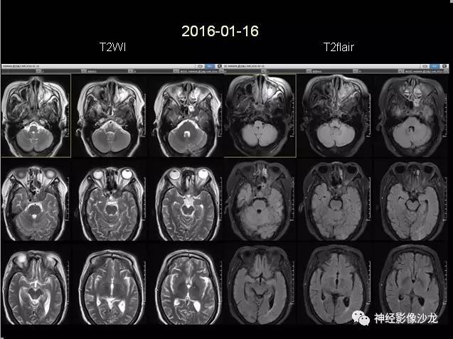 【病例】痛性眼肌麻痹综合征THS一例CT及MR影像表现