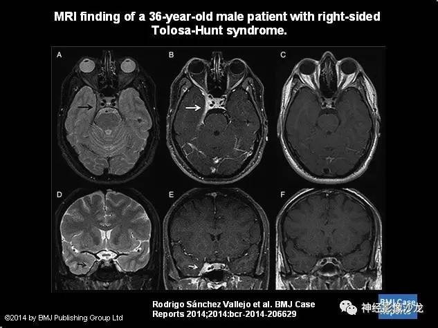 【病例】痛性眼肌麻痹综合征THS一例CT及MR影像表现