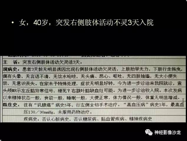 【病例】痛性眼肌麻痹综合征THS一例CT及MR影像表现