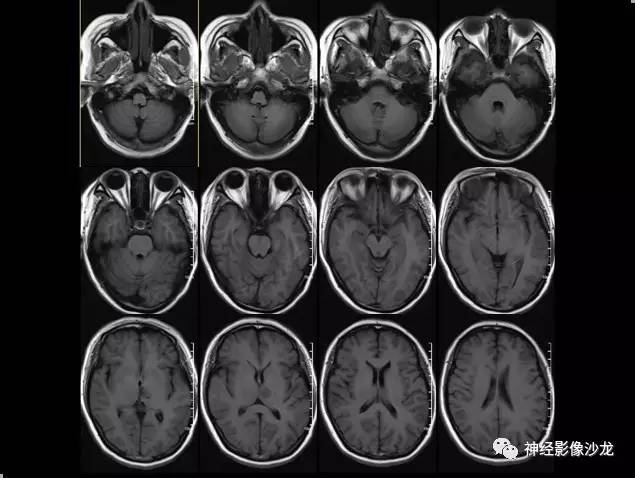 【病例】痛性眼肌麻痹综合征THS一例CT及MR影像表现