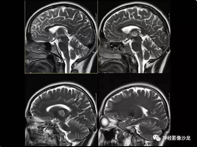 【病例】痛性眼肌麻痹综合征THS一例CT及MR影像表现