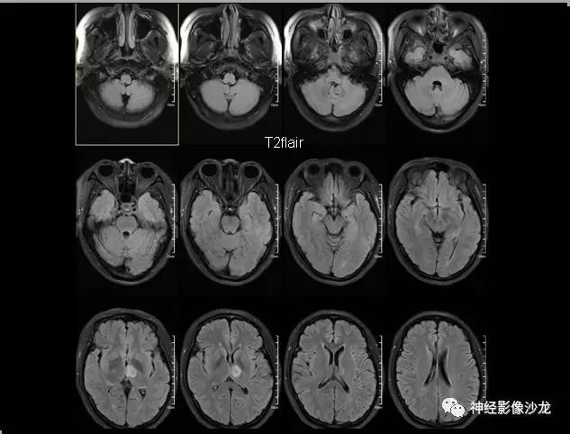 【病例】痛性眼肌麻痹综合征THS一例CT及MR影像表现