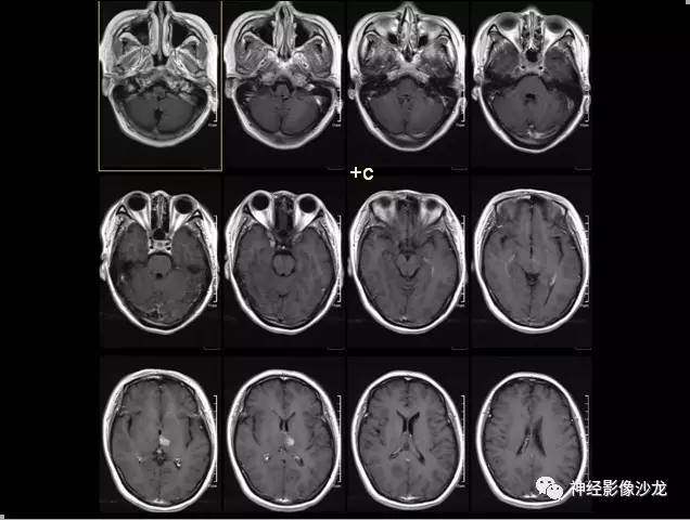 【病例】痛性眼肌麻痹综合征THS一例CT及MR影像表现