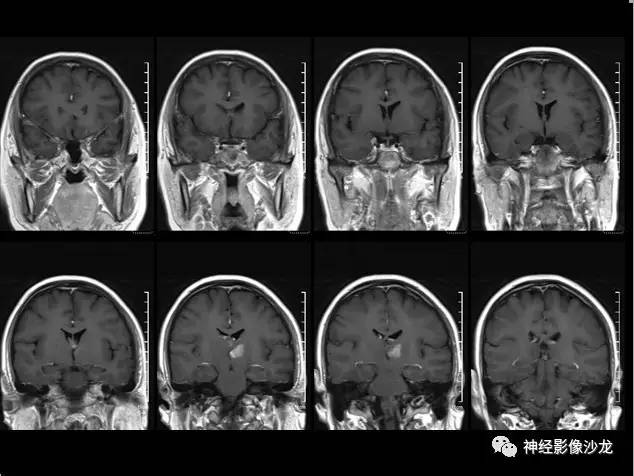 【病例】痛性眼肌麻痹综合征THS一例CT及MR影像表现