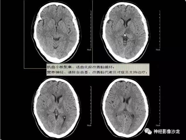 【病例】痛性眼肌麻痹综合征THS一例CT及MR影像表现
