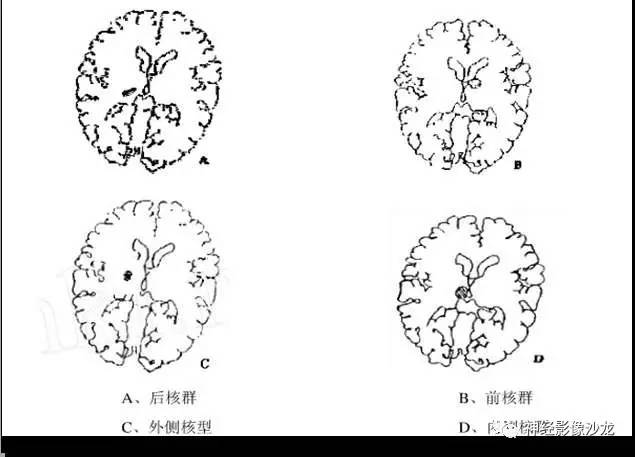 【病例】痛性眼肌麻痹综合征THS一例CT及MR影像表现