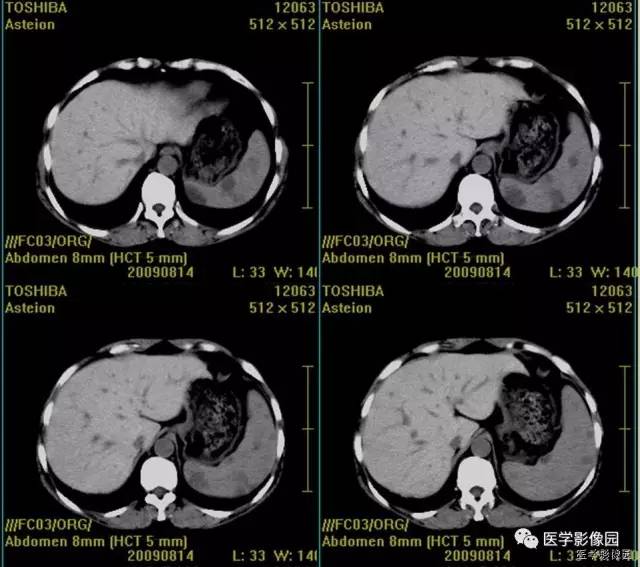【病例】脾脏血管淋巴管瘤1例CT影像表现