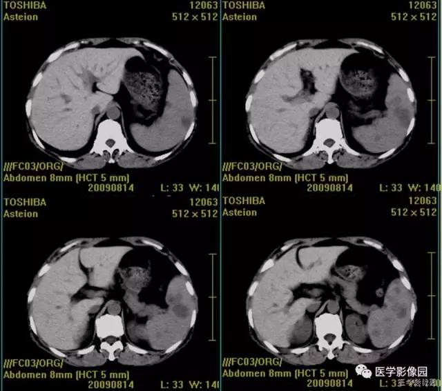 【病例】脾脏血管淋巴管瘤1例CT影像表现 【病例】脾脏血管淋巴管瘤1例CT影像表现