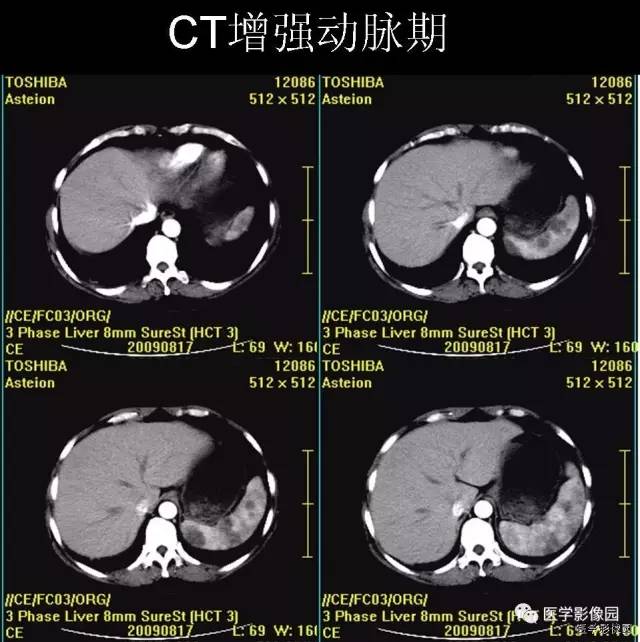 【病例】脾脏血管淋巴管瘤1例CT影像表现 【病例】脾脏血管淋巴管瘤1例CT影像表现