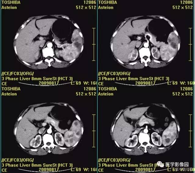 【病例】脾脏血管淋巴管瘤1例CT影像表现 【病例】脾脏血管淋巴管瘤1例CT影像表现