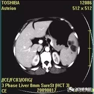 【病例】脾脏血管淋巴管瘤1例CT影像表现 【病例】脾脏血管淋巴管瘤1例CT影像表现