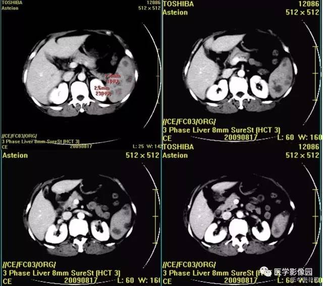 【病例】脾脏血管淋巴管瘤1例CT影像表现 【病例】脾脏血管淋巴管瘤1例CT影像表现