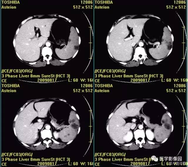 【病例】脾脏血管淋巴管瘤1例CT影像表现 【病例】脾脏血管淋巴管瘤1例CT影像表现