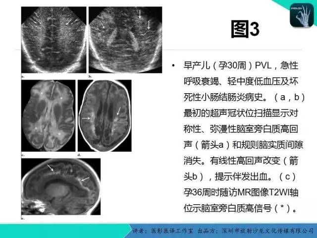 【PPT】新生儿缺氧缺血性脑病多模态影像学表现