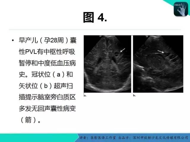 【PPT】新生儿缺氧缺血性脑病多模态影像学表现